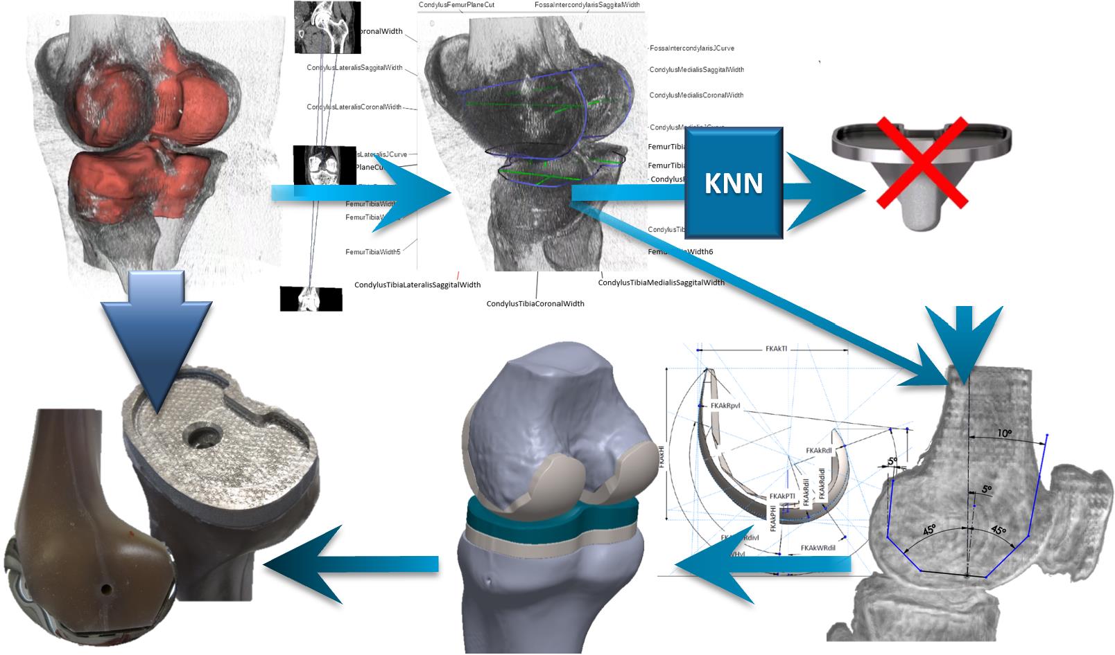 EXPERTEB – expert system for the computer-aided design of individual knee implants